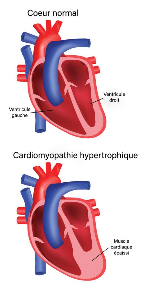 Cardiopathie du chat: cardiomyopathie hypertrophique