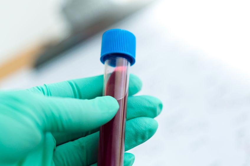 Prise de sang: le dosage de l’urée et de la créatinine constitue un test classique de l’évaluation rénale [123rf.com - olegdudko]